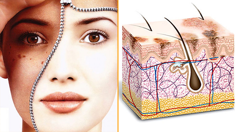 điều trị tàn nhang tại spa