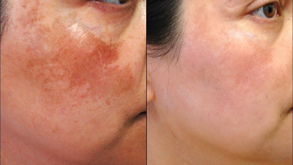 Điều trị trị nám hỗn hợp hiệu quả