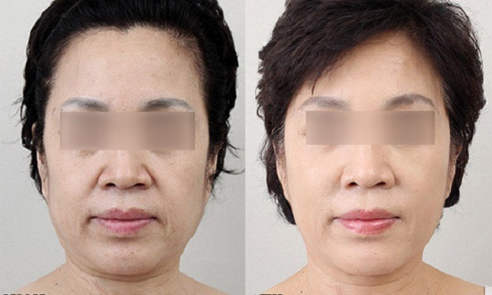 CONTRI HIFU tạo khuôn mặt săn chắc
