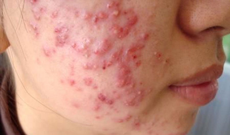 mụn viêm sưng do kích ứng