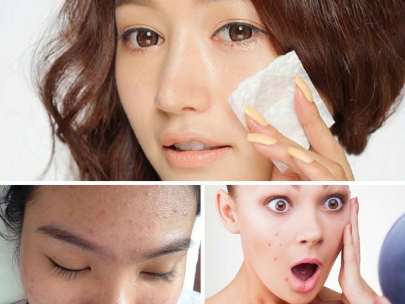 điều trị mụn viêm sưng