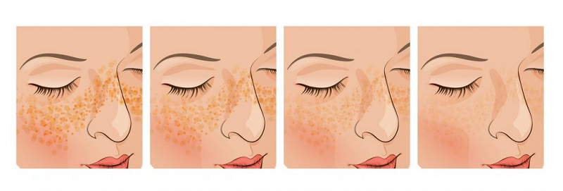 phương pháp điều trị nám chân sâu hiệu quả nhất