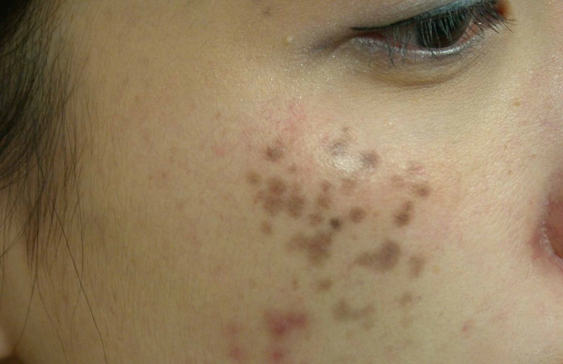 Điều trị nám chân sâu hiệu quả