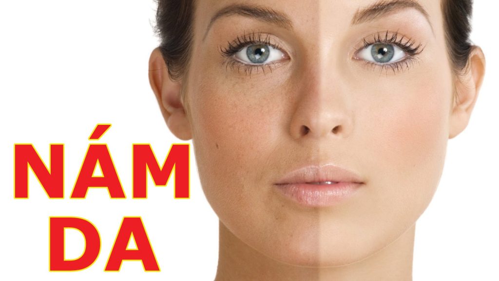 điều trị nám mảng hiệu quả