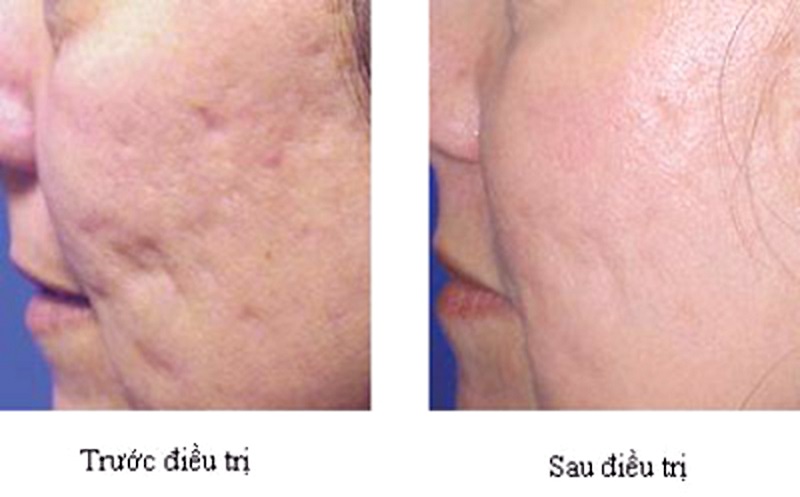 dieu tri seo ro sau mụn