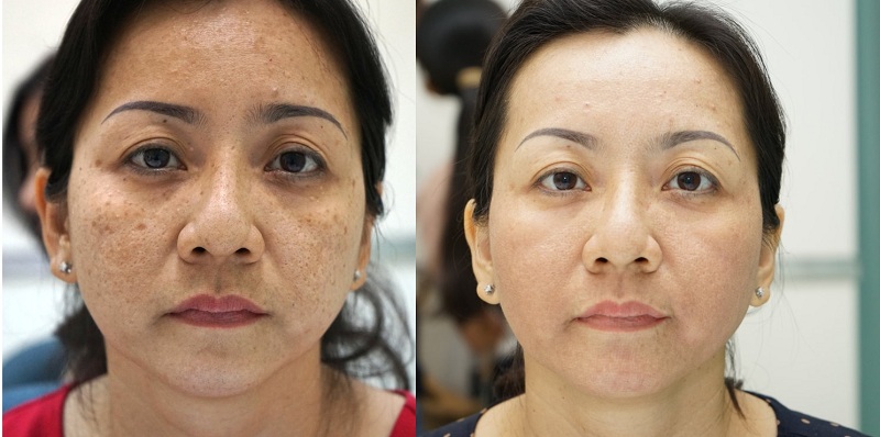 cách điều trị tàn nhang bẩm sinh