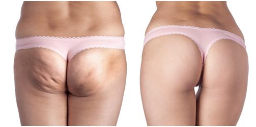 điều trị thâm vùng mông hiệu quả