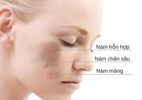các loại nám
