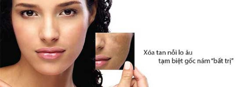 điều trị nám hỗn hợp hiệu quả