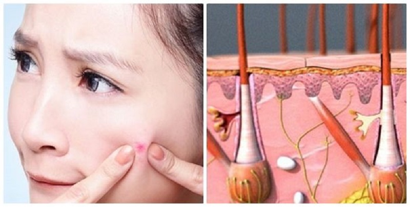 điều trị vết thâm do mụn hiệu quả