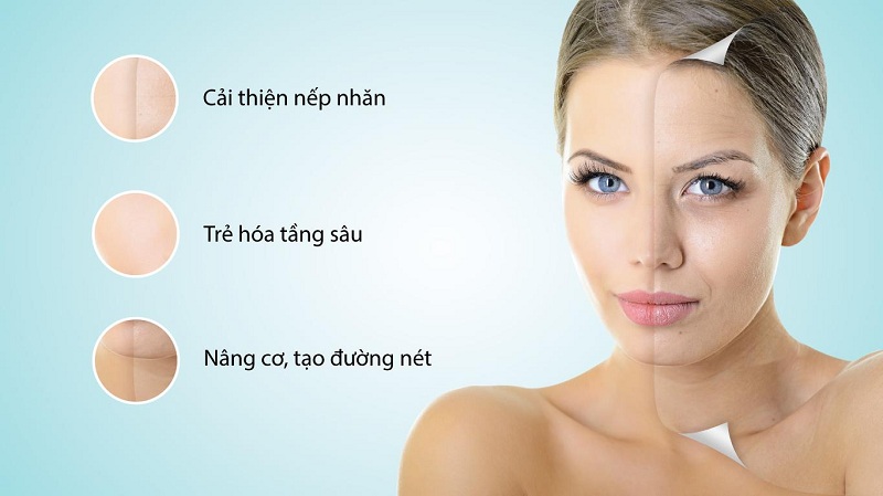 ULTRA NEW nâng cơ tạo hình