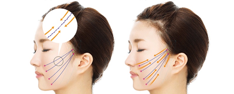 ULTRA NEW nâng cơ tạo hình