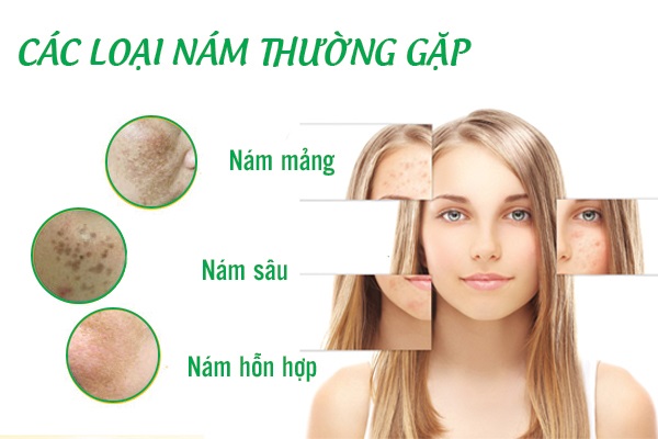 các loại nám thường gặp