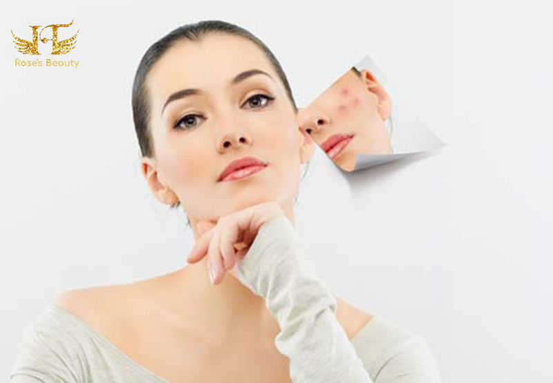 nguyên nhân gây mụn trứng cá