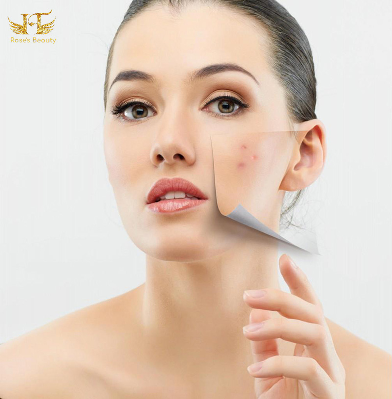 nguyên nhân gây mụn trứng cá