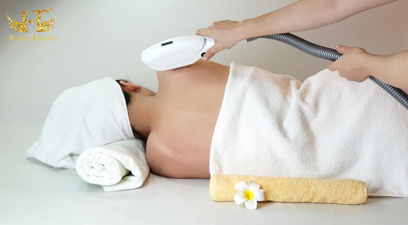 triệt lông cả lưng vĩnh viễn