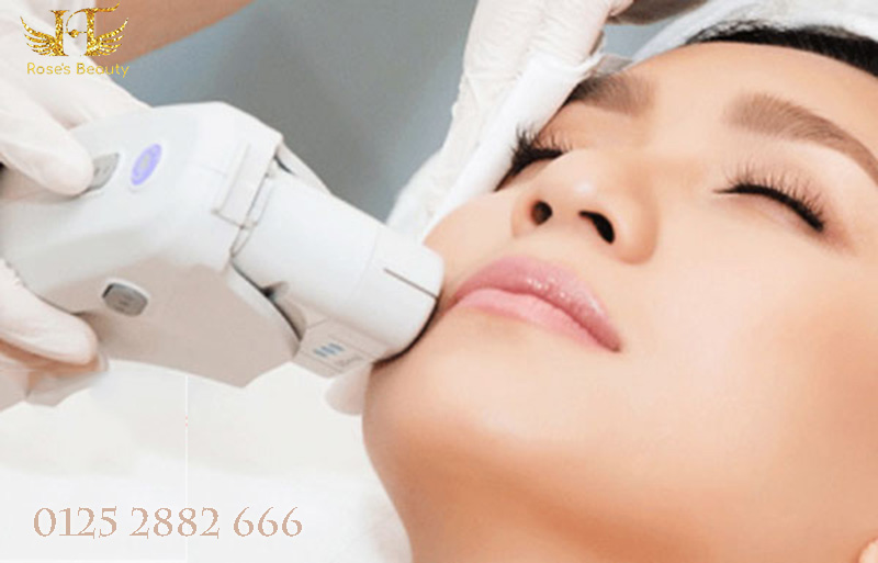 triệt lông mép vĩnh viễn