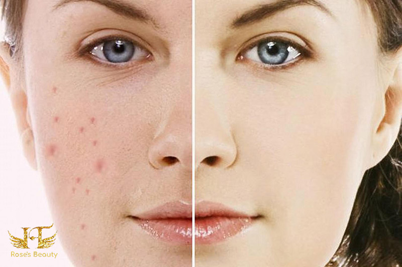điều trị thâm mụn ở hà nội