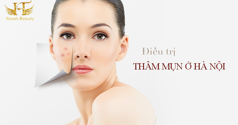 địa chỉ điều trị vết thâm mụn tốt nhất ở hà nội