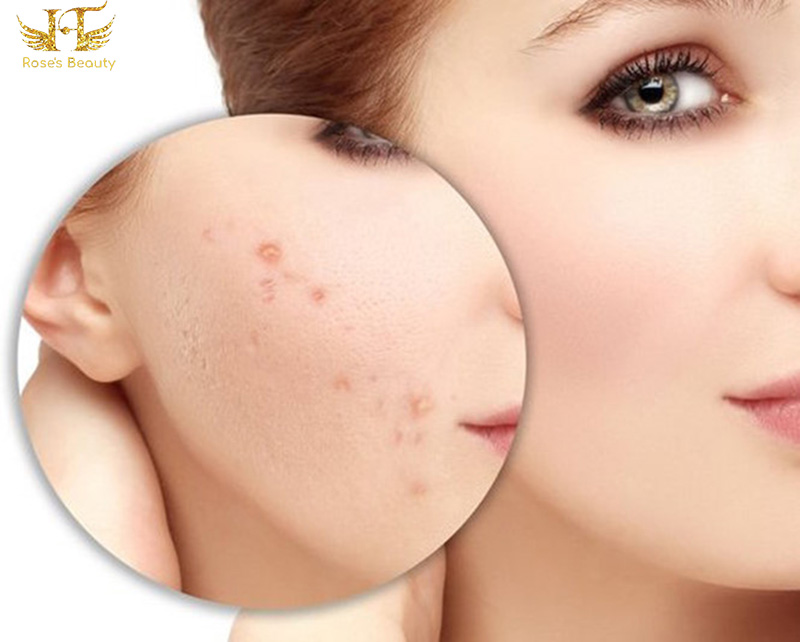 điều trị thâm mụn ở đâu Hà Nội