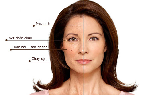 Những dấu hiệu nhận biết nên sủ dụng Công nghệ nâng cơ mặt trẻ hóa da Hifu