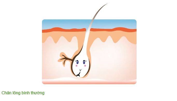 mụn trứng cá hình thành do đâu