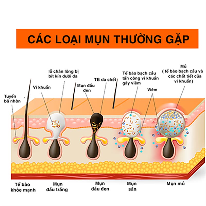 các loại mụn