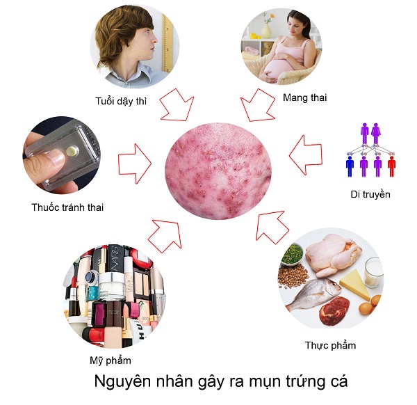 nguyên nhân gây ra mụn trứng cá