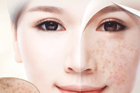 điều trị tàn nhang ở đâu hà nội