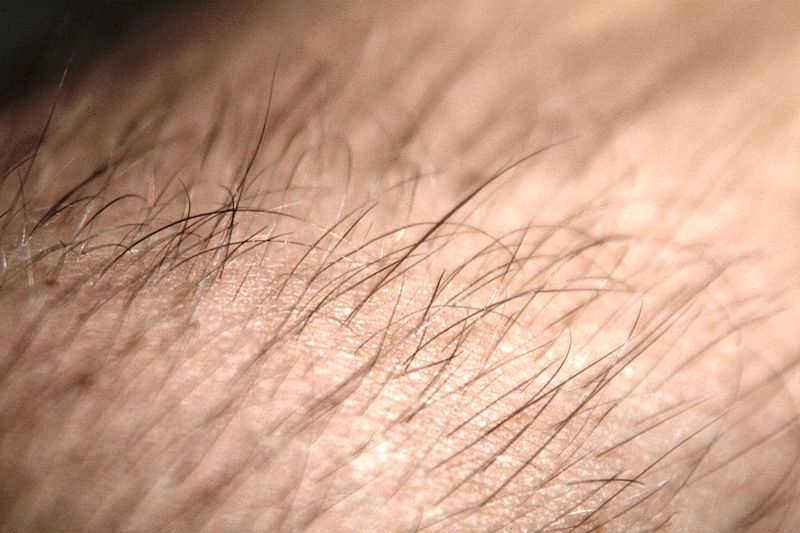 triệt lông tại hà nội