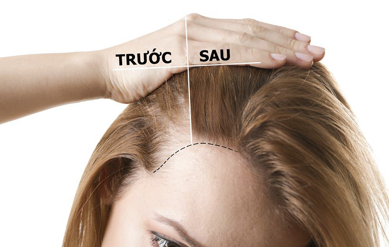 Thuốc trị rụng tóc dht blocker